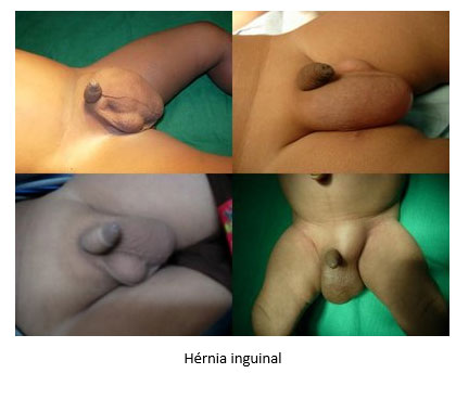 hernia-inguinal