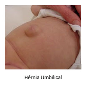 hérnia-umbilical